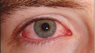 إكتشاف علاج جديد لمرض العين 