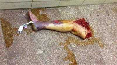 مصر.. ساق مبتورة ملقاة بمستشفى الإسكندرية تثير الرعب