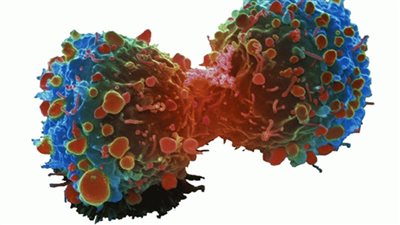 عقاقير علاج العظام قد تمنع الإصابة بسرطان الثدي