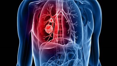 طبيب فرنسي يكتشف الجزء المسبب للخلايا السرطانية فى الرئة