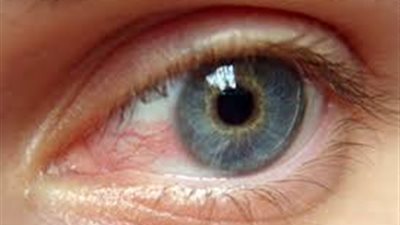 اختبار قياس ضغط العين قد يساعد في منع فقدان البصر