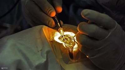 أول عملية جراحية ناجحة داخل العين باستخدام روبوت