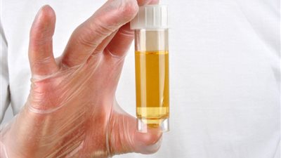 تطوير تحليل جديد يمكنه التنبؤ بفرص الإصابة بسرطان البروستاتا