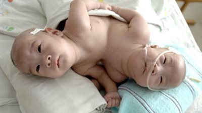 الصين تنجح في فصل توأم ملتصق بمساعدة تكنولوجيا ثلاثية الأبعاد 