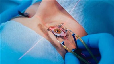 جراح فرنسي: الليزر الأفضل لعلاج قصر النظر بين كبار السن