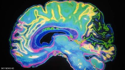 دراسة تكشف العلاقة بين شكل الدماغ والاضطرابات العصبية