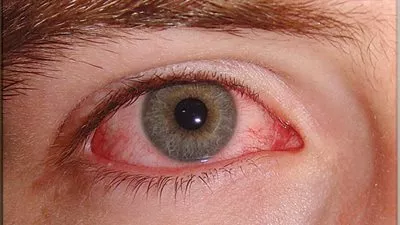 إكتشاف علاج جديد لمرض العين 