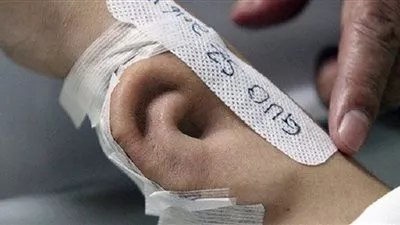 زراعة أذن في يد مريض