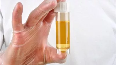 تطوير تحليل جديد يمكنه التنبؤ بفرص الإصابة بسرطان البروستاتا