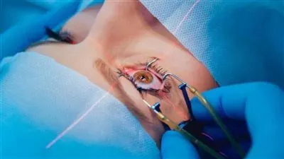 جراح فرنسي: الليزر الأفضل لعلاج قصر النظر بين كبار السن