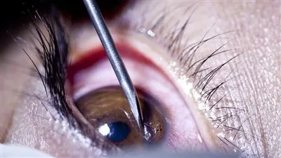 وزارة «الصحة» تصدر ضوابط واشتراطات استيراد قرنيات العيون